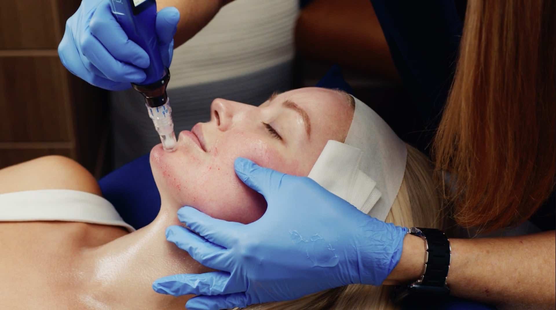 Practitioner treating a patient's cheek with SkinPen